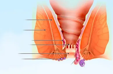 Haemorrhoids (Piles)